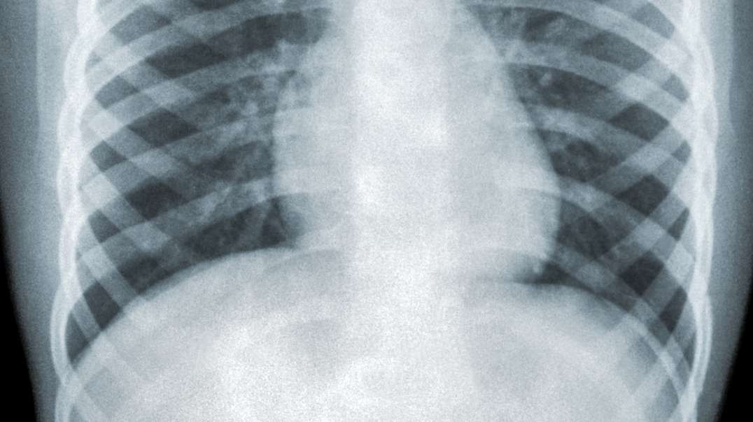 HERE WE GO: Mystery Pneumonia From China Hits US, Meets Definition Of 